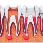 root canal treatment