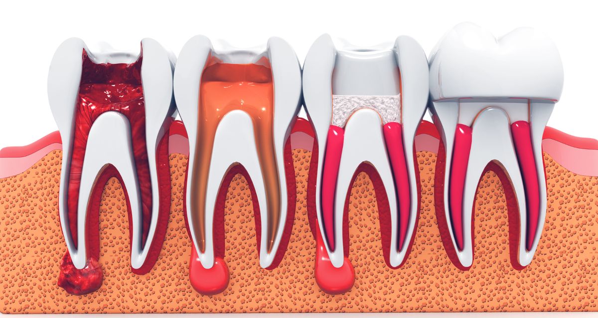 root canal treatment