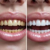 Tooth Whitening